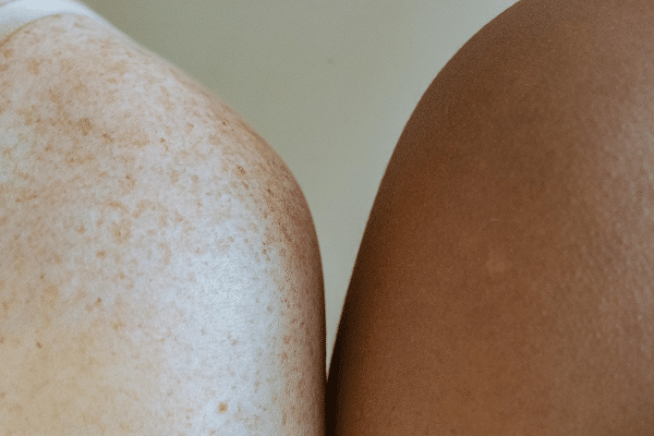 Skin Cancer Screening - What to Know and When to Get Checked